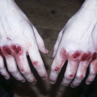 bloody knuckles