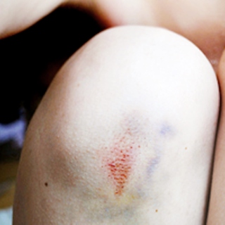 bruise