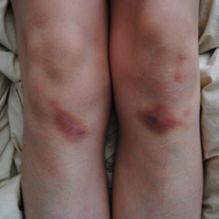 Bruises and bites.