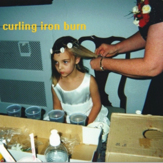curling iron burn