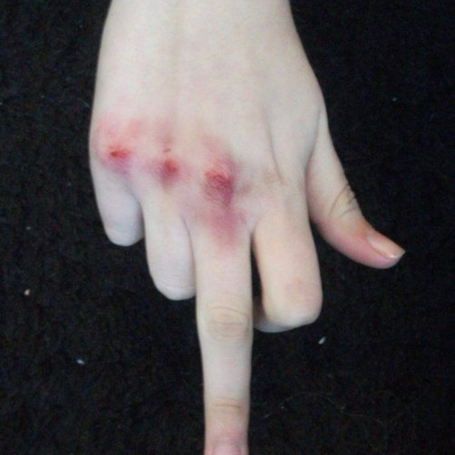 bruised knuckles