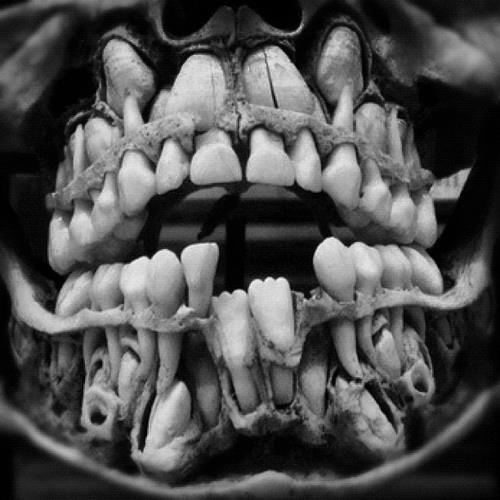 Supernumerary Teeth