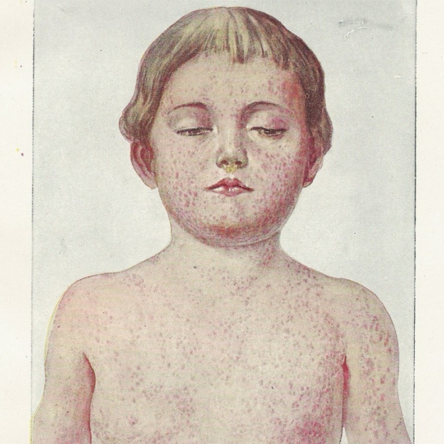 Measles - The infectiology study playlist